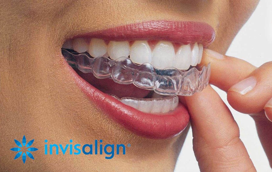 Invisalign alineadores